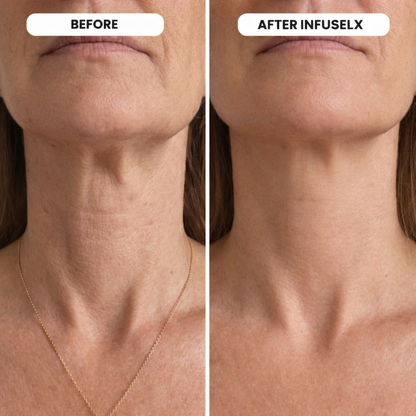 InfuseLX Micro Infusion System