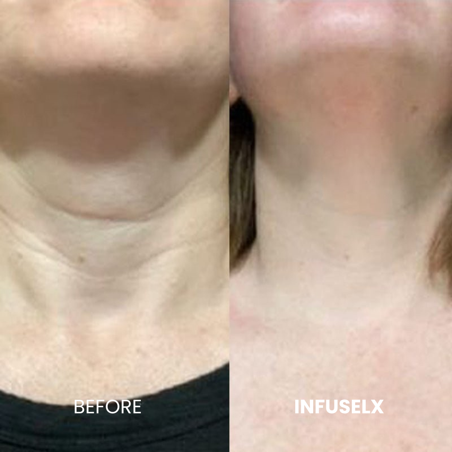 The InfuseLX™ Micro Infusion System