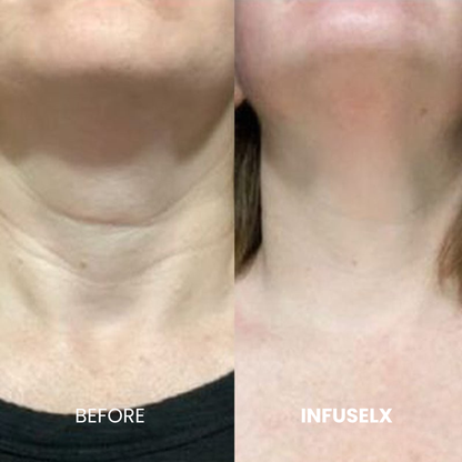 The InfuseLX™ Micro Infusion System