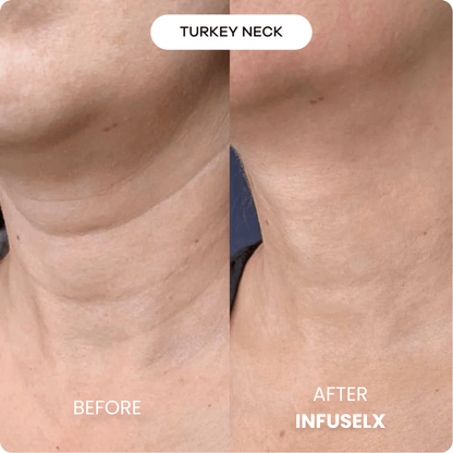 The InfuseLX™ Micro Infusion System