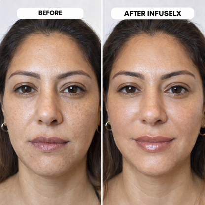 InfuseLX Micro Infusion System