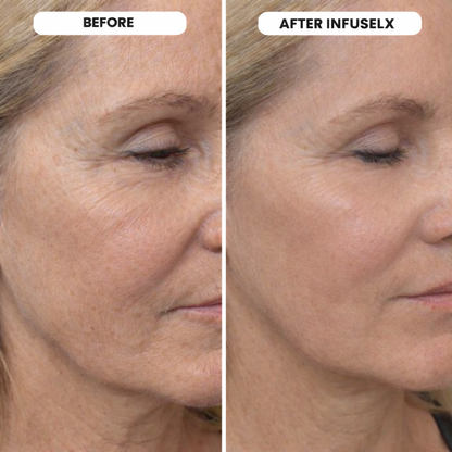 InfuseLX Micro Infusion System